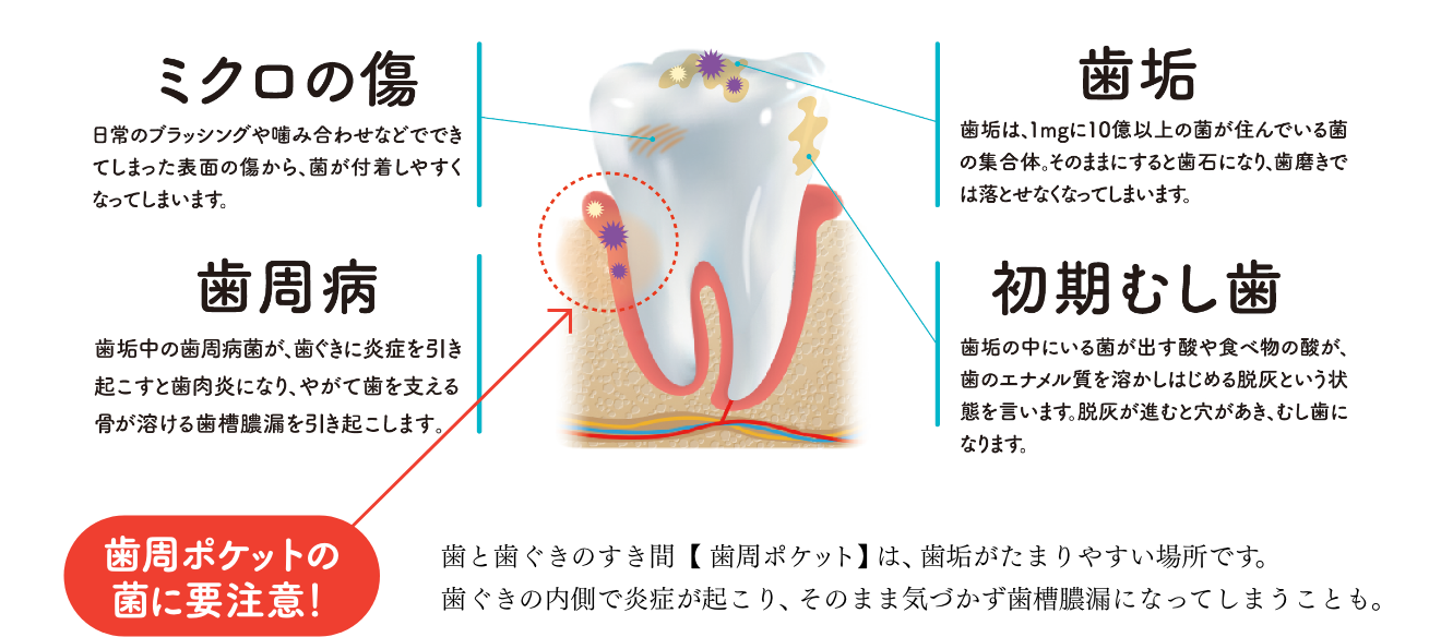 歯と歯ぐきのすき間【 歯周ポケット 】は、歯垢がたまりやすい場所です。歯ぐきの内側で炎症が起こり、そのまま気づかず歯槽膿漏になってしまうことも。